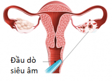 LIỆU PHÁP GÂY XƠ TRONG ĐIỀU TRỊ U LẠC NỘI MẠC TỬ CUNG Ở BUỒNG TRỨNG